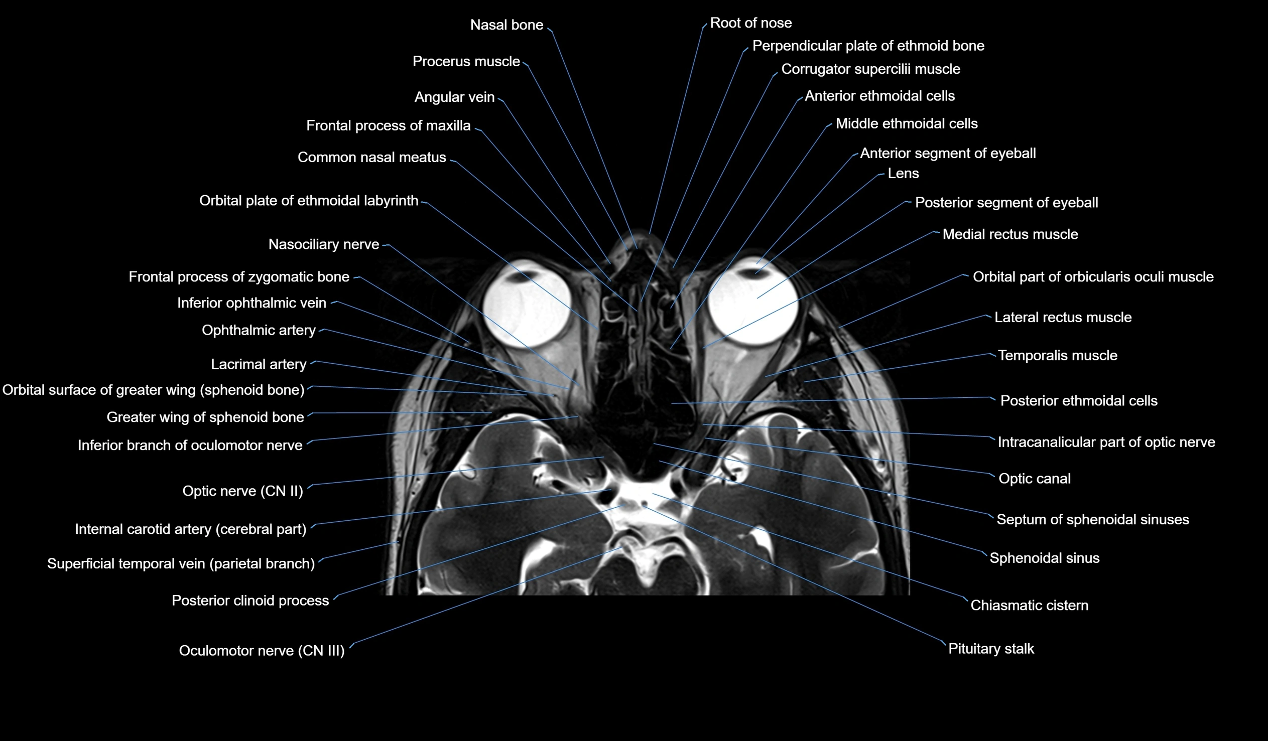 MRI face & paranasal sinuses(PNS) labelled  coronal  cross sectional anatomy 3T radiology  image-img-00001-00022.webp